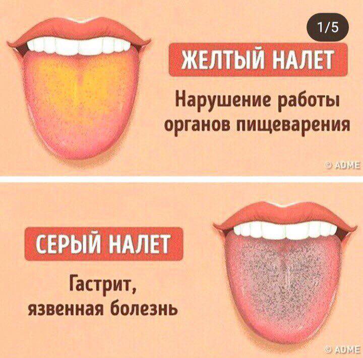 ​Сірий наліт на язиці