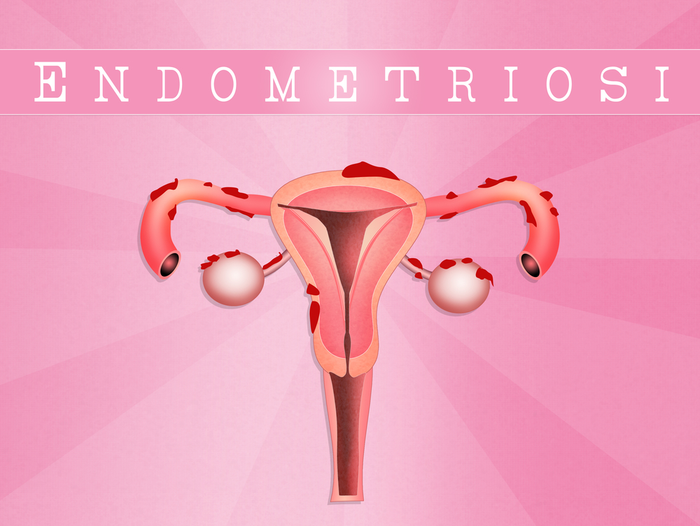 Изображение матки с эндометриозом