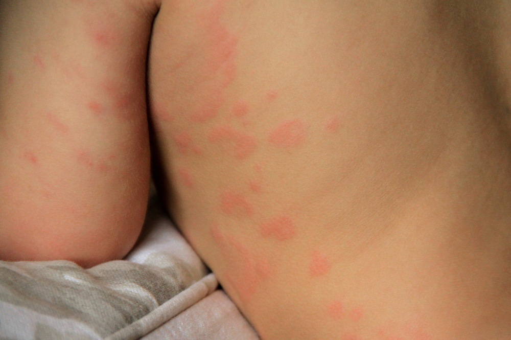 Аллергия у малыша до года