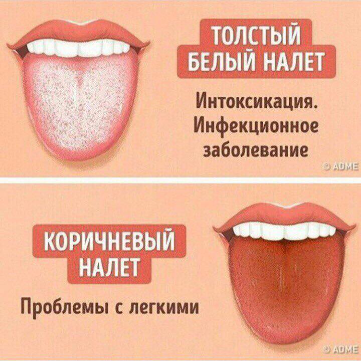 ​Білий або коричневий наліт на язиці