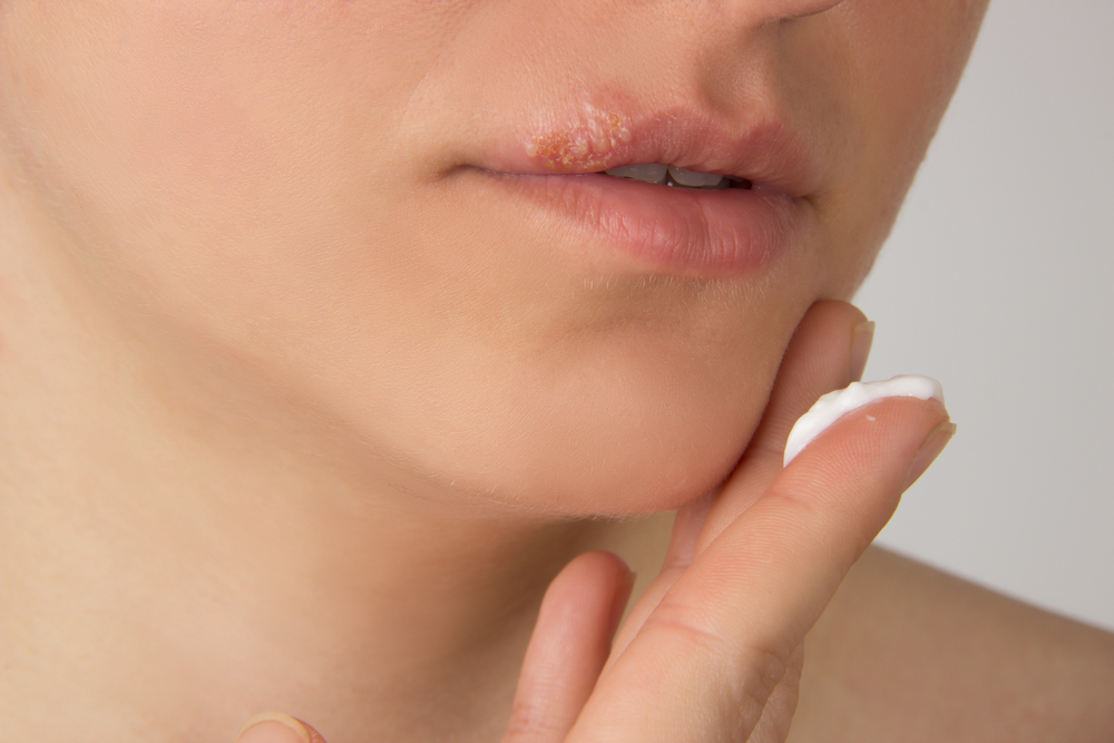 Лечение герпеса на губах