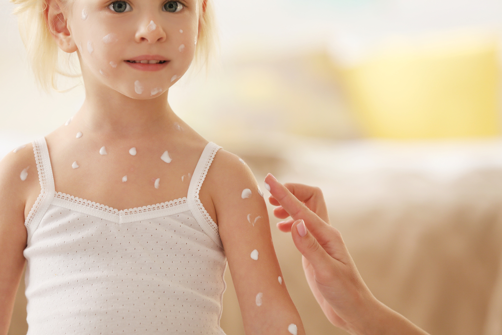 Укуси комарів - як полегшити свербіж у дитини