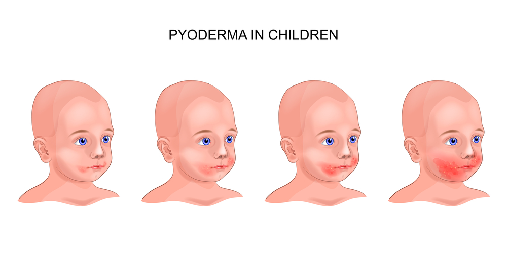 ​піодермія у дітей