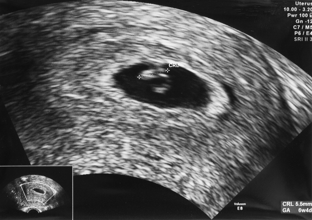 Плод на 7 неделе беременности на экране монитора УЗИ
